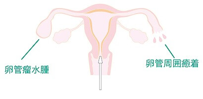 卵管の通過性を調べる卵管通水検査