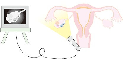 卵胞の発育、子宮や卵巣の形態などをモニターに映し出す経腔超音波診断